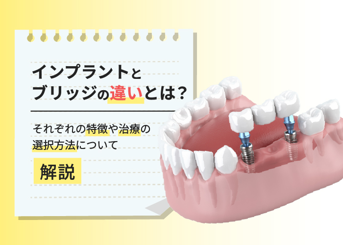 インプラントとブリッジの違いとは？それぞれの特徴や治療の選択方法について解説